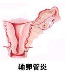 妇炎丸治疗输卵管炎
