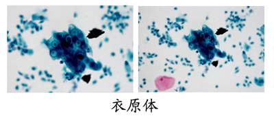 衣原体感染能自愈吗