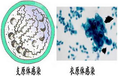 如何判断是否感染衣原体支原体