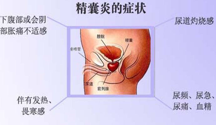 精囊炎不严重需要治疗吗