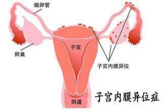 子宫内膜异位症是怎么导致不孕的