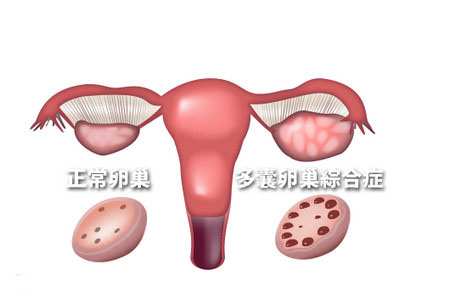 女性多卵巢综合征的原因有哪些？