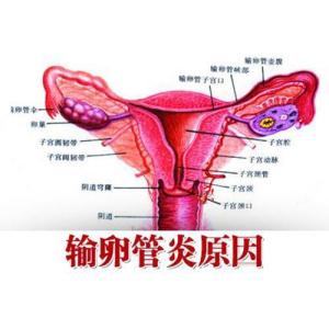 输卵管炎中医治疗效果好吗