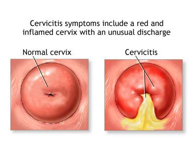cervicitis.png