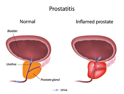 prostatitis.jpg
