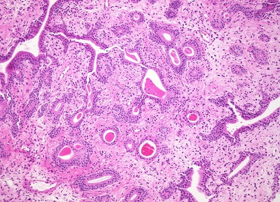 Cystitis Glandularis.jpg