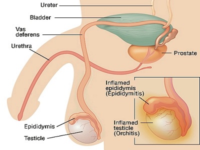 Testosterone treatment for men