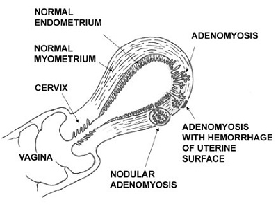 Adenomyosis.jpg
