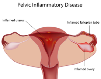 pelvic-inflammatory-disease.png