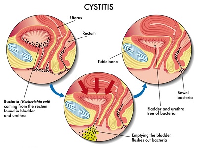 Cystitis-2.jpg