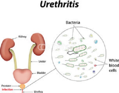 Urethritis.jpg