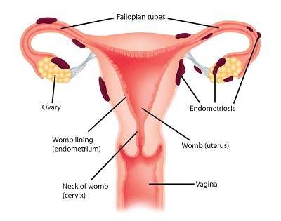 SOC 152C endometriosis pic.jpg