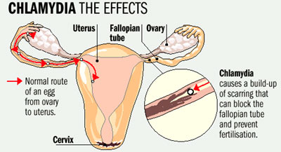 chlamydia-1.jpg