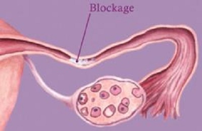 Fallopian-Tube-Blockage.jpg