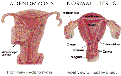 education-adenomyosis.gif