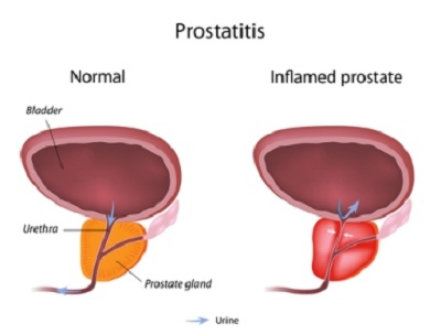 prostatitis.jpg