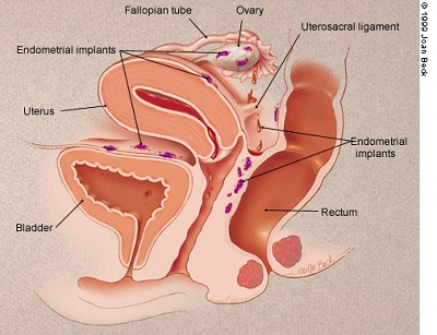 endometriosis-3.jpg