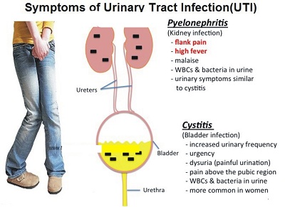 symptoms-of-uti.jpg