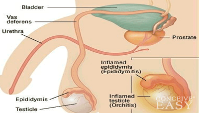 does-epididymitis-cause-infertility.png