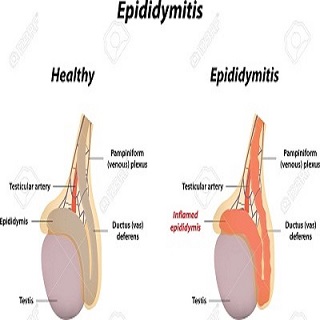 Epididymitis