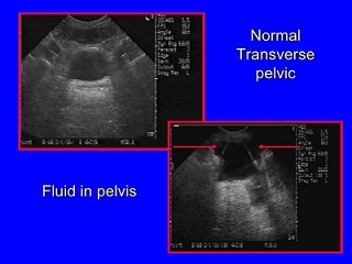 fluid in pelvis