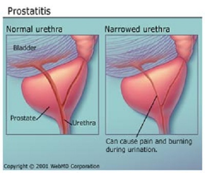 prostatitis