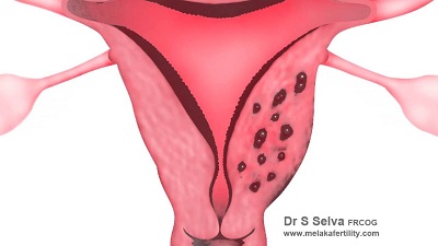 Adenomyosis