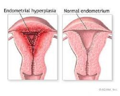 endometrial hyperplasia