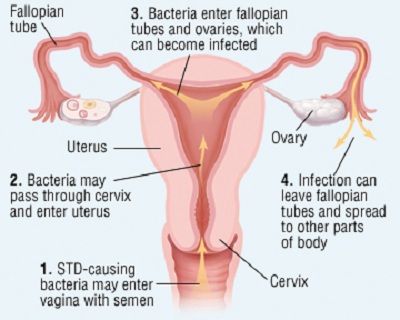 pelvic inflammatory disease