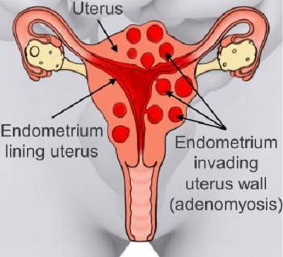 adenomyosis