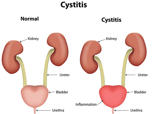 Urinary-tract-infection-cystitis-disease_副本.jpg