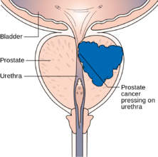 non-bacterial prostatitis.jpg