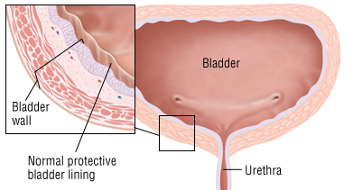 interstitial cystitis.jpg