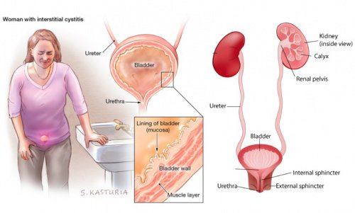 Bladder Infection 2.jpg