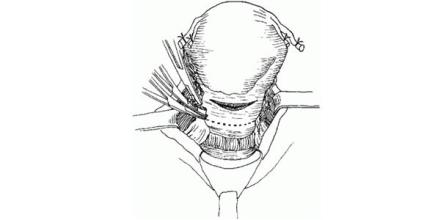 cervix bleeding 2.jpg