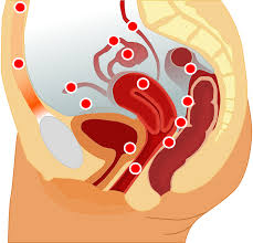 endometrial hyperplasia.jpg