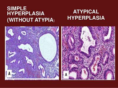 atypical endometrial hyperplasia.jpg