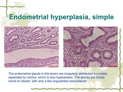 endometrial hyperplasia 3.jpg