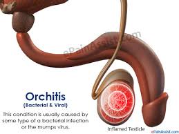 orchitis.jpg