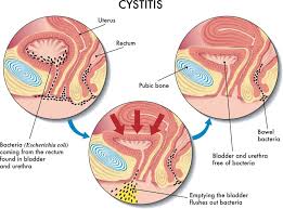 treatment for bladder infection.jpg