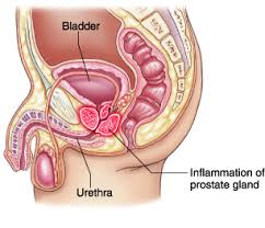 prostatitis alternative treatment.jpg