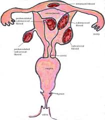 endometriosis treatment option.jpg