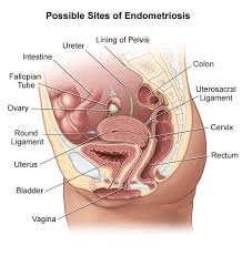 endometriosis symptoms relief.jpg