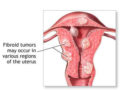 Adenomyosis natural cures.jpg