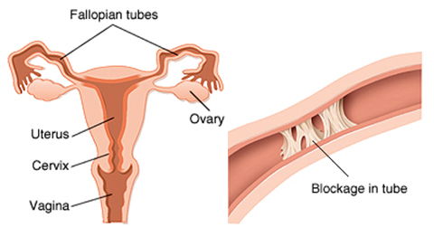 natural treatment for fallopian tubes blockage.jpg