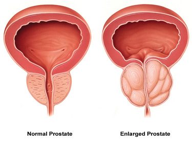 prostatitis treatment.jpg