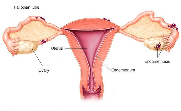 How Is Endometriosis Treated.jpg